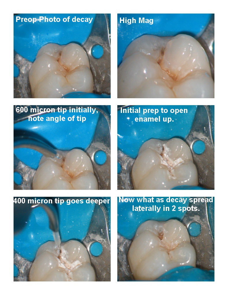 Microdental lower molar pg 1.jpg